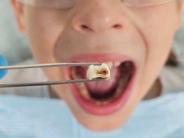 Best Root Canal Emergency Dentist  in Mount Pleasant, TX